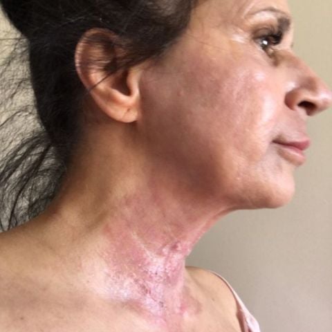 Halsen under behandling – Bild från LaDerma av Michaela B.