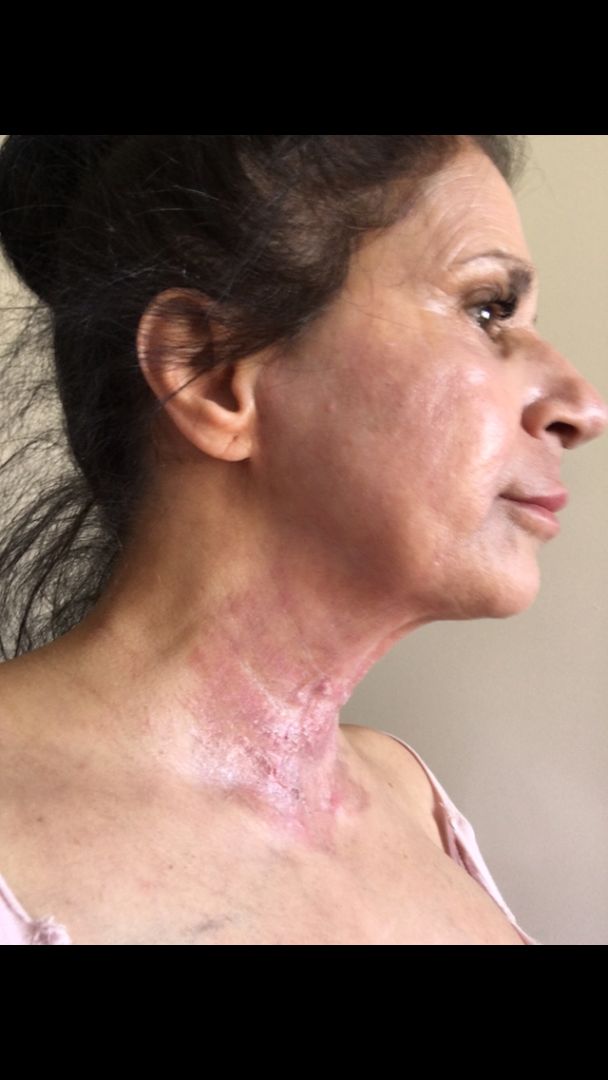 Halsen under behandling – Bild från LaDerma Hudvård och Skönhetsklinik av Michaela B. (2019-12-04)